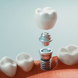 diagram showing the parts of a dental implant