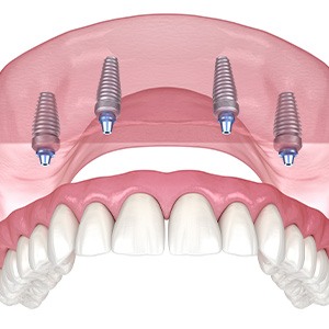 Illustration of an implant denture